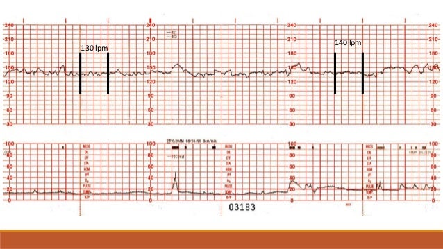 monitoria fetal